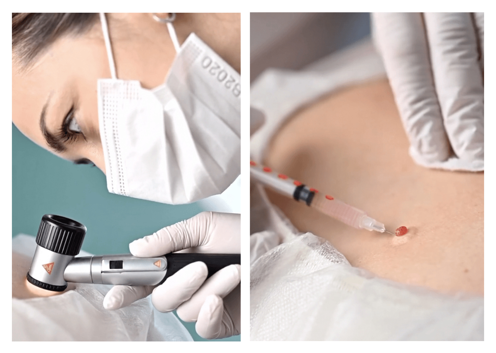 vidalennya-rodimok-na-livomu-berezi-kiyeva-nemyrovska-beauty-clinic Діагностика родимки у дерматоонколога у Києві